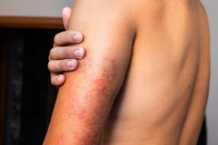 vasculita-cauze-simptome-si-cum-poate-fi-tratata-boala-inflamatorie.jpg