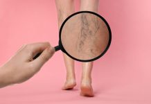 Tratament varice: soluții moderne pentru insuficiența venoasă cronică