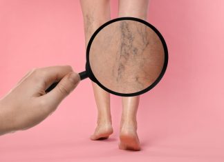 Tratament varice: soluții moderne pentru insuficiența venoasă cronică