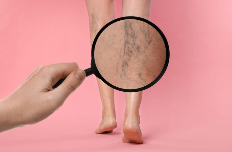 Tratament varice: soluții moderne pentru insuficiența venoasă cronică